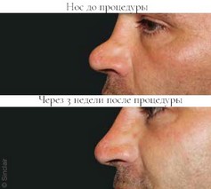 Ellanse- фотографии пациента до и после коррекции носа