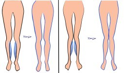 При "ложной кривизне" ног делают коррекцию методом установки имплантов голеней