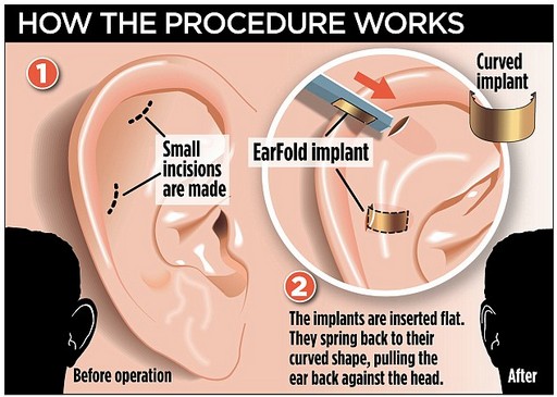 Пластинки earFold ™ для коррекции формы ушей без хирургии