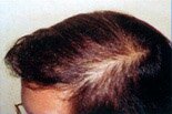 После коррекции лысины