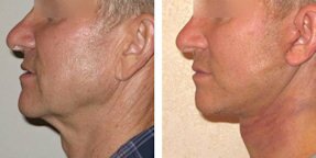Отвисшая кожа на шее и подбородке