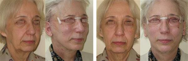 Комбинированный лифтинг