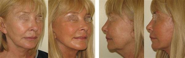 Комбинированный лифтинг