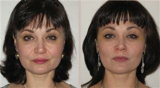 Мини-лифтинг лица